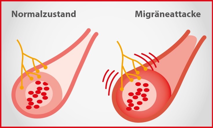 Migräne Blutgefäße